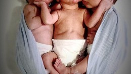 Üçüz Bebeklerden Çınar Alp Yaşam Savaşını Kaybetti