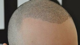 Saç Ektirmeye Gittiği Hastanede Öldü