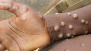 Panik artıyor; Maymun Çiçeği Türkiye’de görüldü mü?