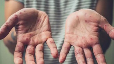 EYVAH! ‘Maymun Çiçeği’ paniği; Test yaptılar