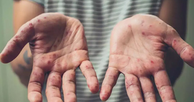 EYVAH! ‘Maymun Çiçeği’ paniği; Test yaptılar