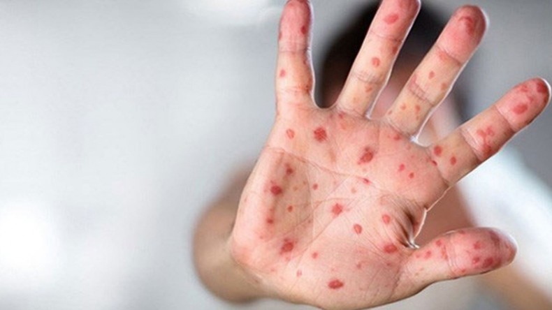 Korkutan uyarılar: İşte Maymun Çiçeği belirtileri