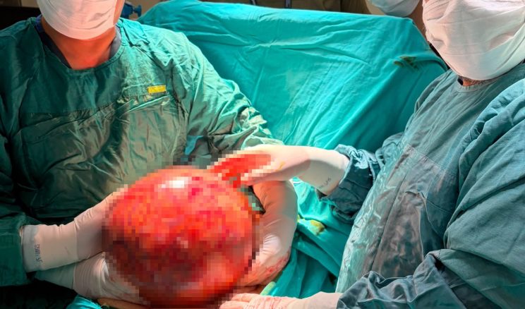 Kocaeli’de ameliyattan korkan adamın karnından 6,5 kiloluk dev tümör çıkarıldı
